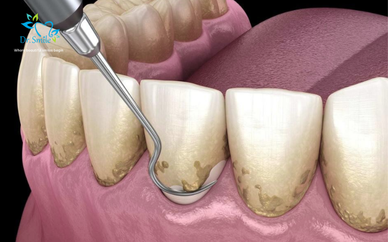 Dental scaling helps prevent gum inflammation