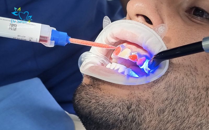 Professional teeth whitening in about 60 minutes