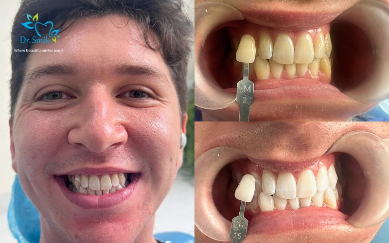 Teeth whitening results
