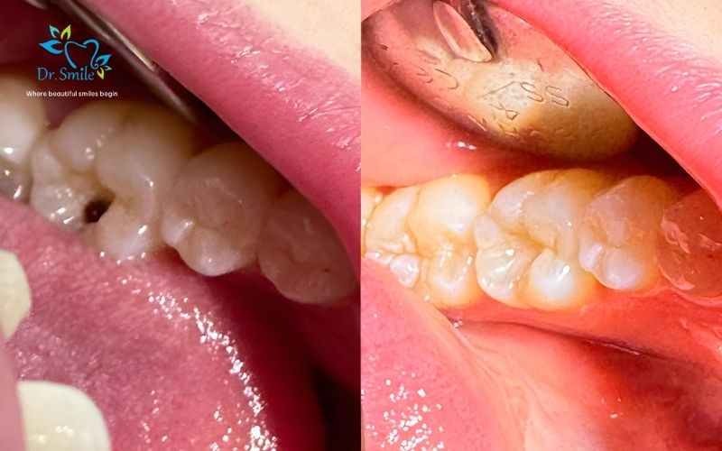 Cosmetic dental filling
