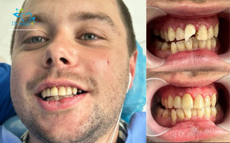 Dental filling services at Dr.Smile Dental Clinic