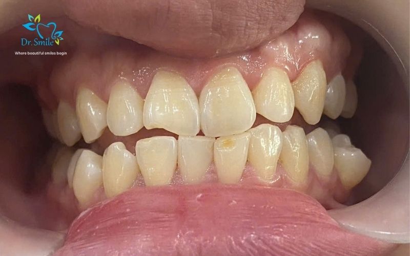 Close-up of damaged or misaligned teeth requiring urgent dental assessment