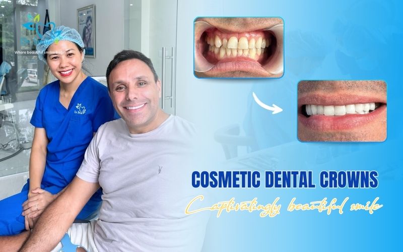 A dentist and patient smiling next to before-and-after photos of dental veneers