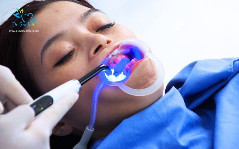 The demand for teeth whitening Hanoi has increased