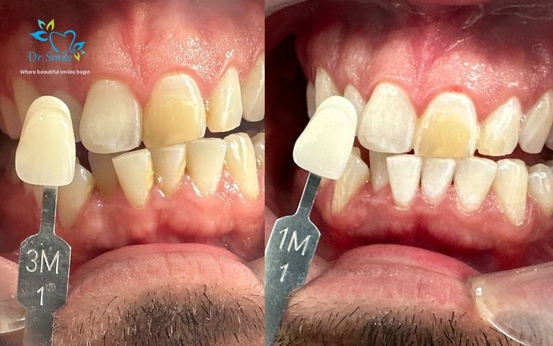 Teeth whitening is suitable for people with yellowed teeth