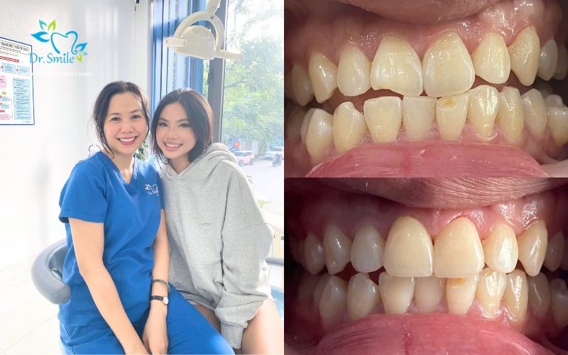 Final placement and bonding