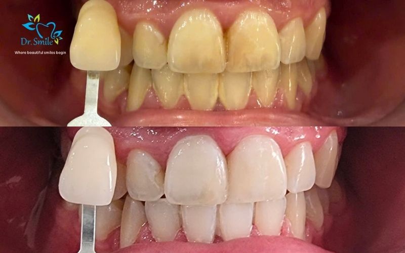 Choose Dr.Smile for 60-minute teeth whitening in Hanoi
