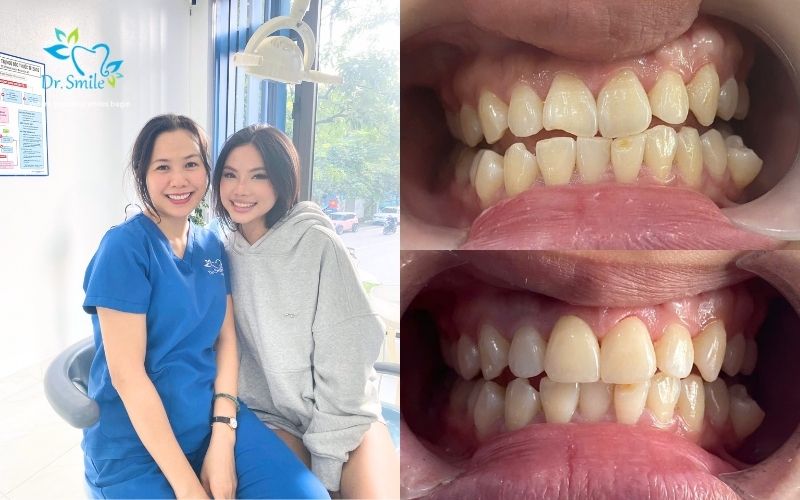 More patients are choosing veneers and crowns