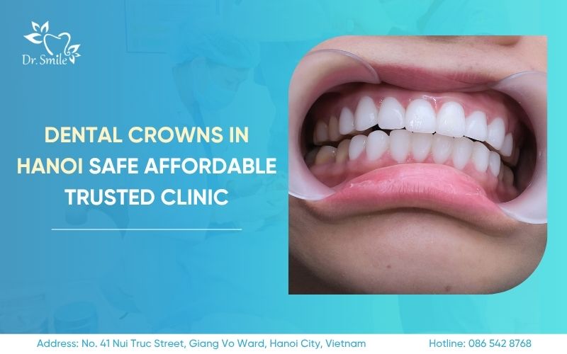 dental crowns in Hanoi