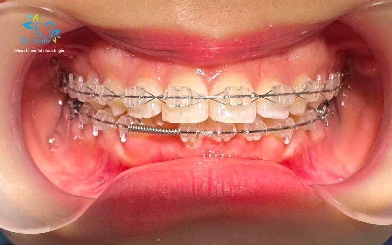 Modern orthodontic options available in Hanoi