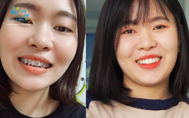 Building confidence through a healthier smile