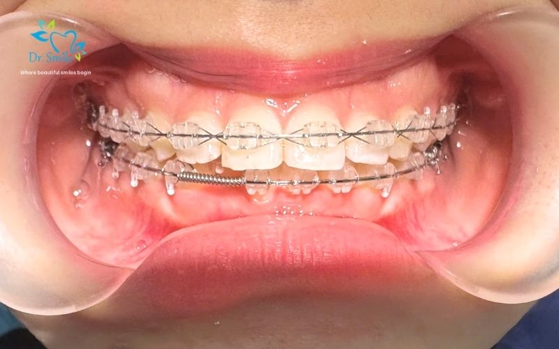 Discover orthodontic care at Dr.Smile dental clinic