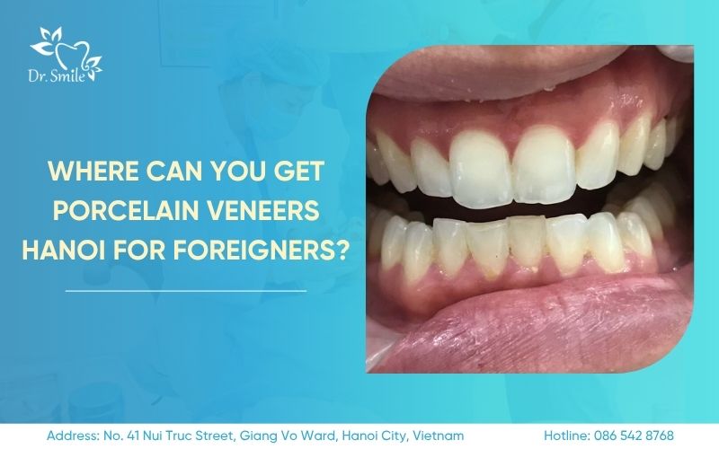 porcelain veneers hanoi for foreigners