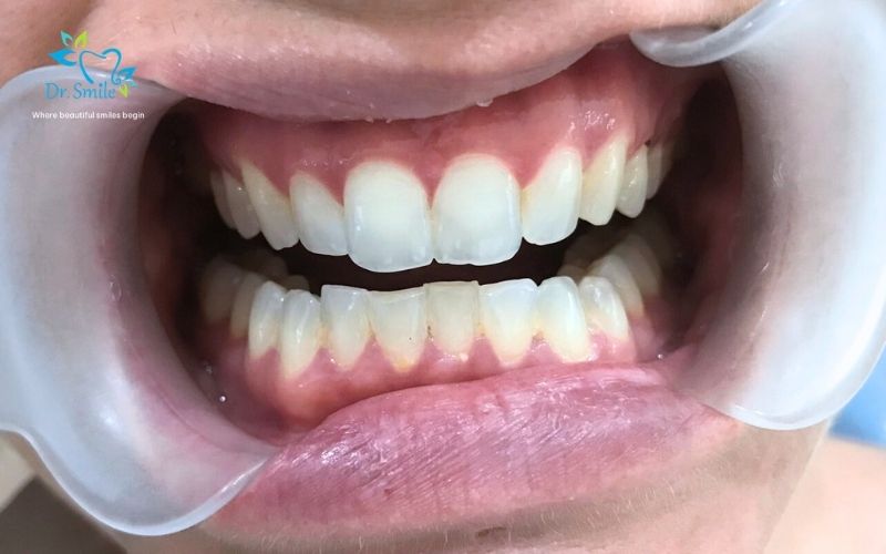 What can porcelain veneers improve?