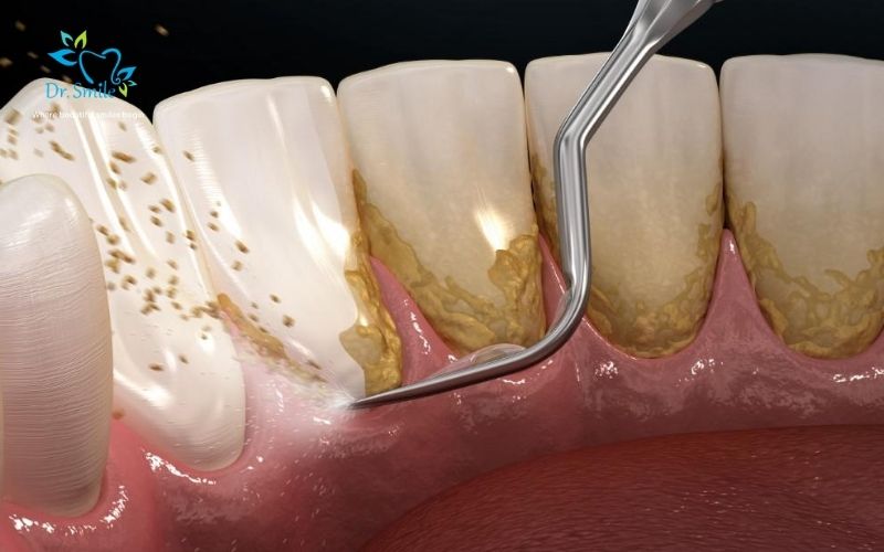 The benefits of professional dental cleaning