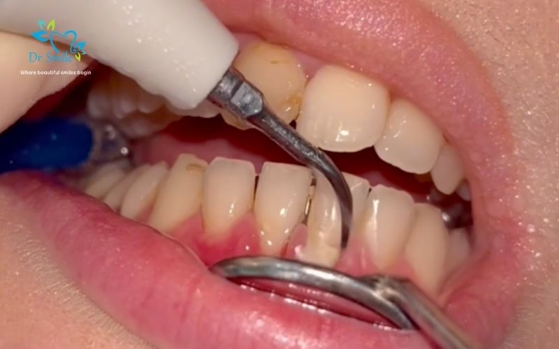 Patients choosing quick dental cleaning Hanoi for busy travelers