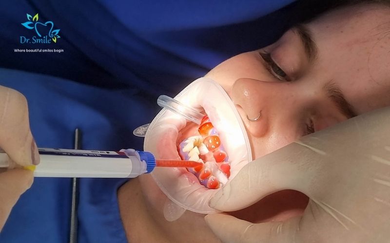 Maintaining your whitening results