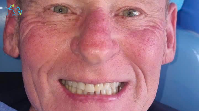 Customized veneer treatment starts with a comprehensive evaluation.