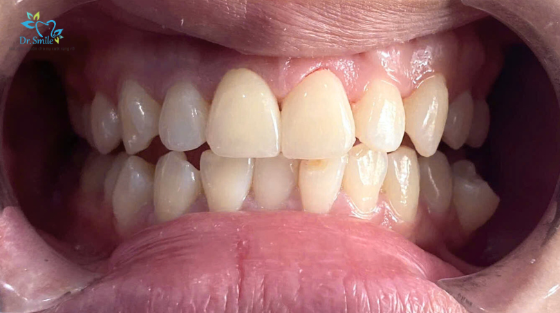 A confident smile begins with customized veneer treatment.