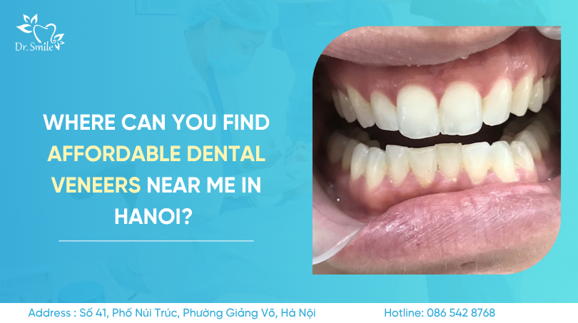 affordable dental veneers near me