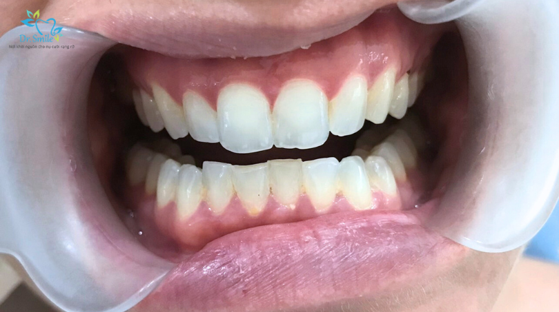 cheap porcelain crowns near me