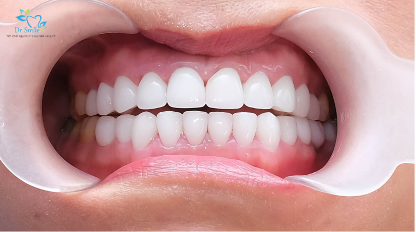 dental veneer clinic near me