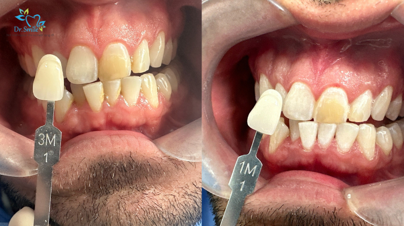 teeth whitening Hanoi price