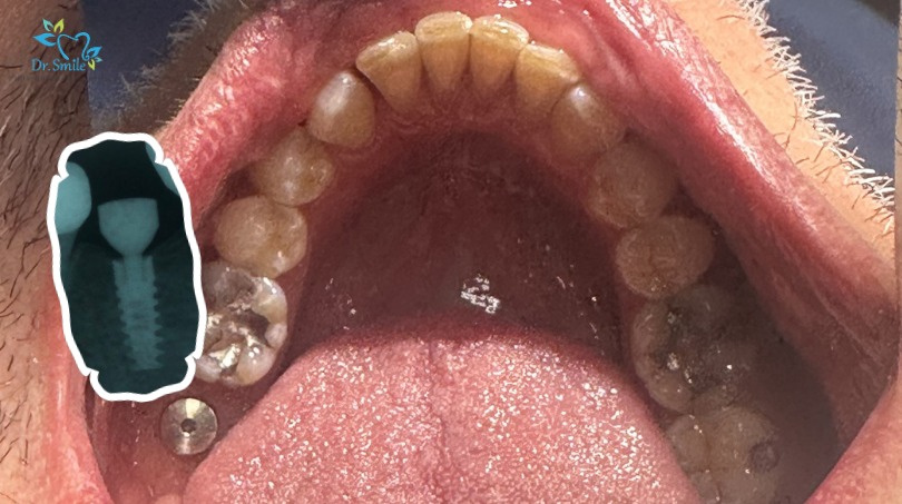 What can make your final implant bill higher?