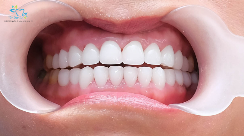 What are porcelain veneers and how do they improve your smile?