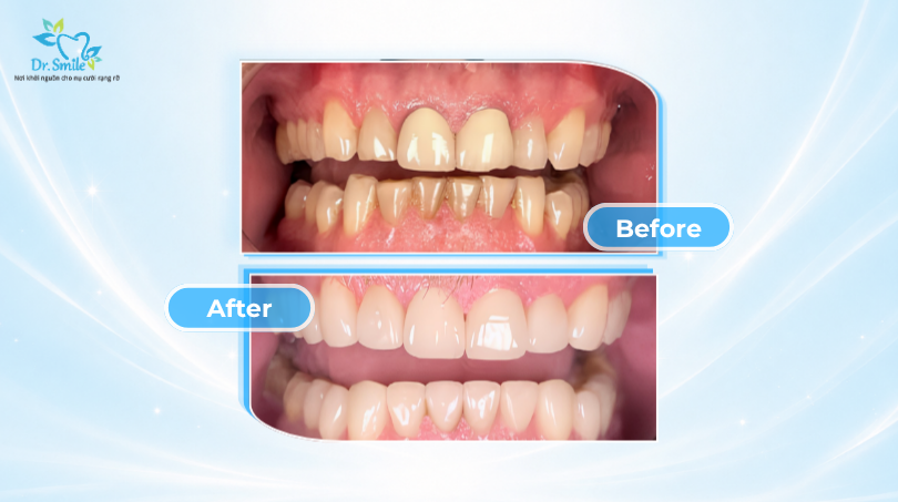 Porcelain veneer aftercare Hanoi