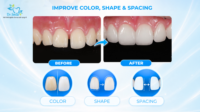 The porcelain veneer procedure Hanoi