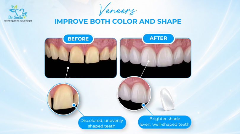 Porcelain veneer procedure Hanoi