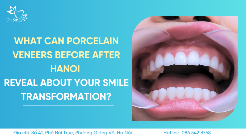 porcelain veneers before after Hanoi