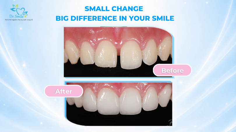 Small change big difference in your smile