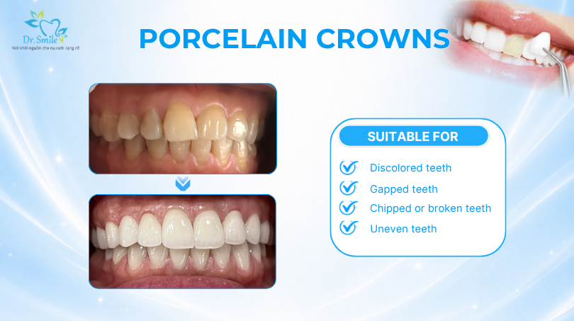 Natural tooth color and translucency
